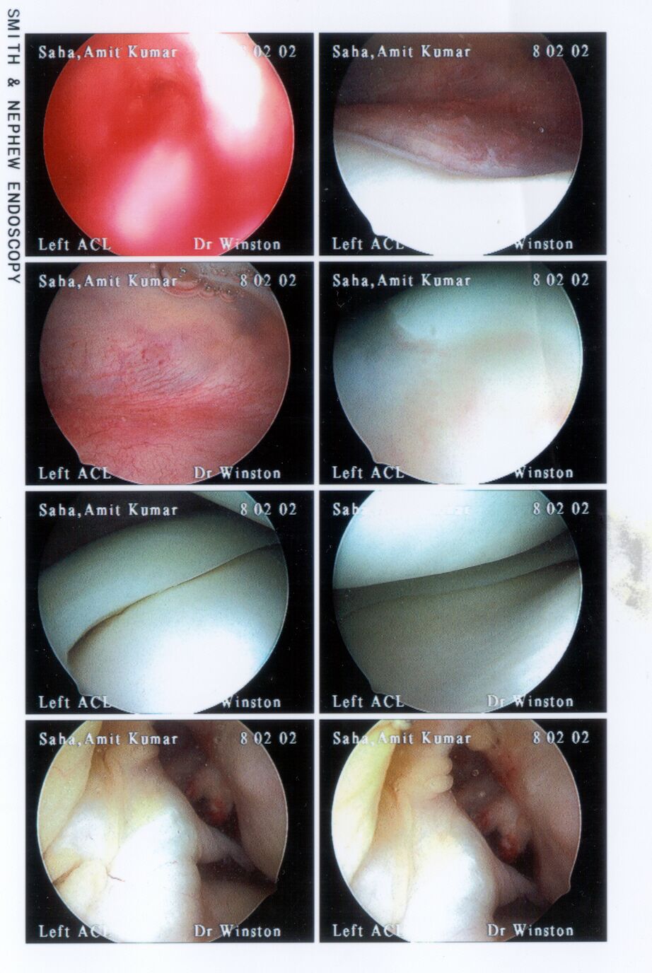Endoscopic Images of Knee Interior 